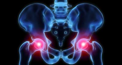 hip-dysplasia